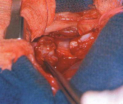 Проксимальный (слева) и дистальный концы грудного отдела пищевода после резекции участка каудального конца пищевода, перфорированного инородным телом (костью).