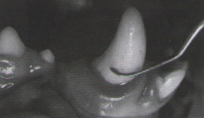 Рис. 5. Правильное наддесневое расположение кюреты относительно поверхности зуба