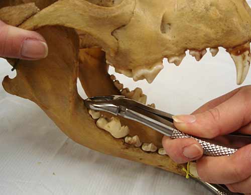 Удаление второго моляра нижней челюсти щипцами для премоляров 